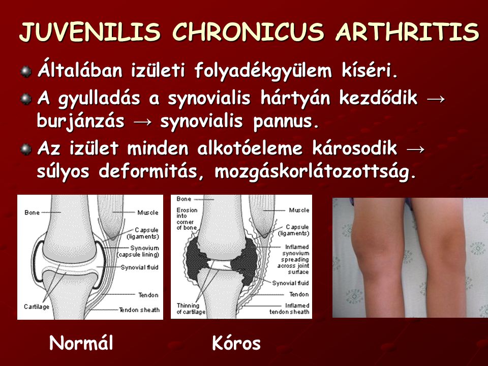 krónikus arthrosis